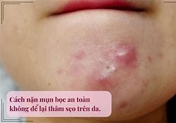 Cách Tự Nặn Mụn Tại Nhà